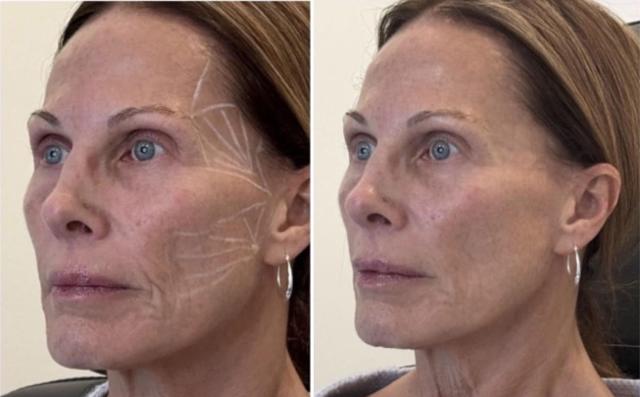 Lip Filler result at Slim Studio FACE & BODY in Atlanta, GA
