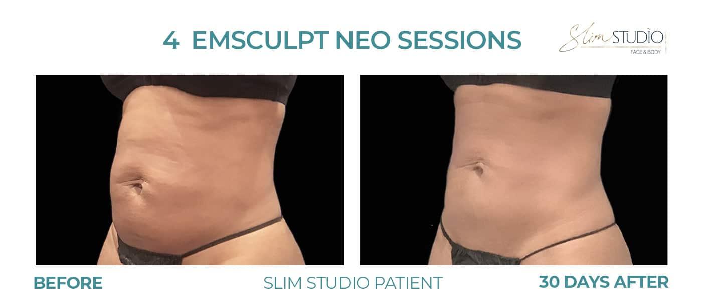 Slim Studio FACE & BODY result — Atlanta, GA