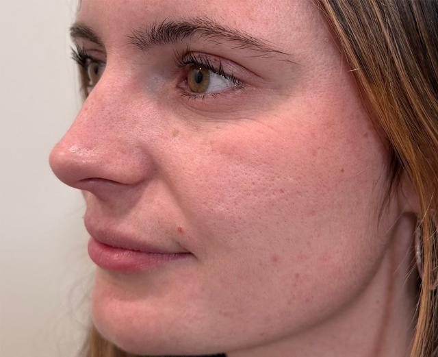 Lip Filler before at Slim Studio FACE & BODY in Atlanta, GA