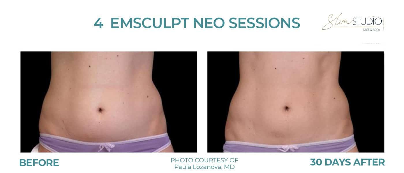Slim Studio FACE & BODY result — Atlanta, GA