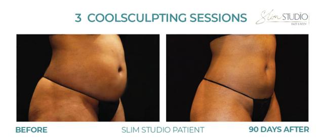 CoolSculpting result at Slim Studio FACE & BODY in Atlanta, GA