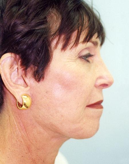 Facelift after at Vivian Hernandez, MD, FACS in Boca Raton, FL