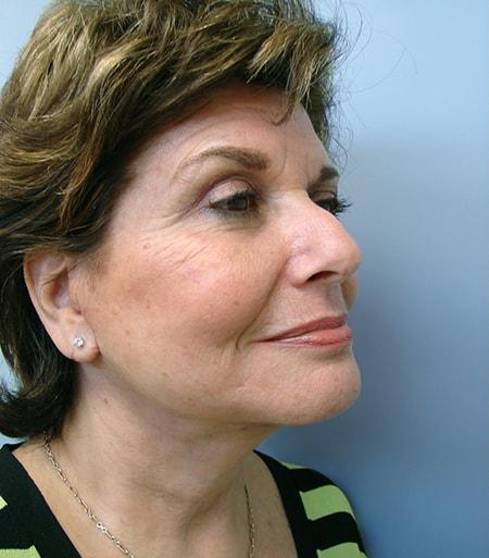 Vivian Hernandez, MD, FACS facelift after — Boca Raton, FL