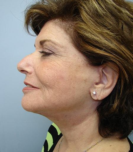 Vivian Hernandez, MD, FACS facelift after — Boca Raton, FL
