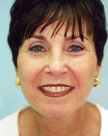 Vivian Hernandez, MD, FACS facelift after — Boca Raton, FL