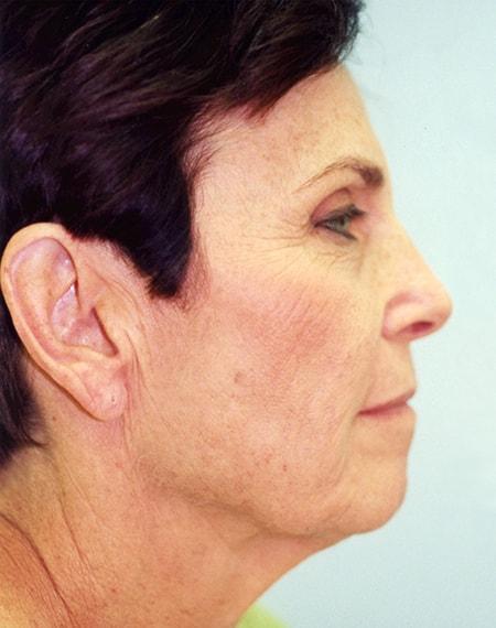 Facelift before at Vivian Hernandez, MD, FACS in Boca Raton, FL