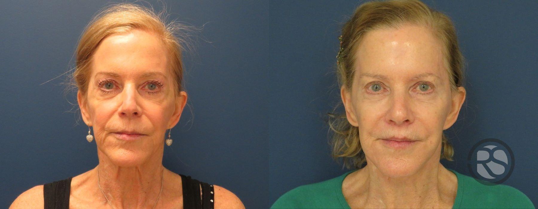 New England Reconstructive & Aesthetic Surgery facelift result — Newton, MA
