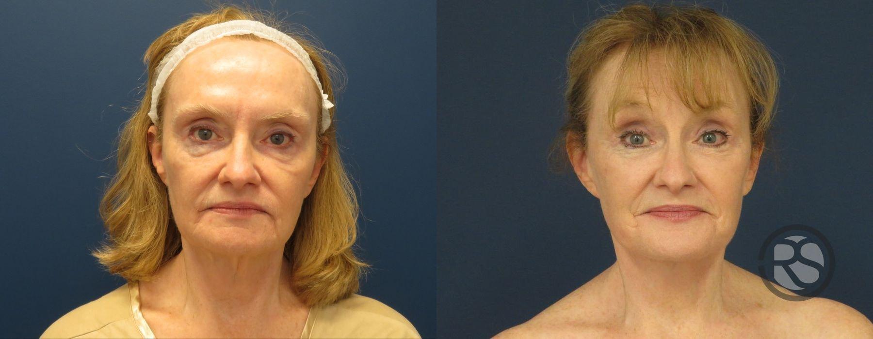 New England Reconstructive & Aesthetic Surgery facelift result — Newton, MA