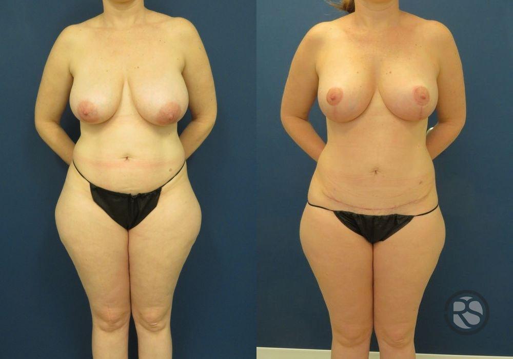New England Reconstructive & Aesthetic Surgery mommy makeover result — Newton, MA