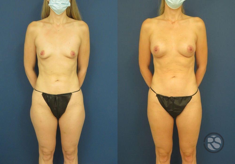 New England Reconstructive & Aesthetic Surgery mommy makeover result — Newton, MA