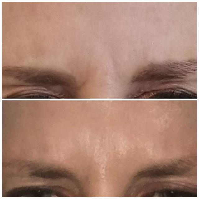 Botox result at Bella Tu Medical in St. George, UT