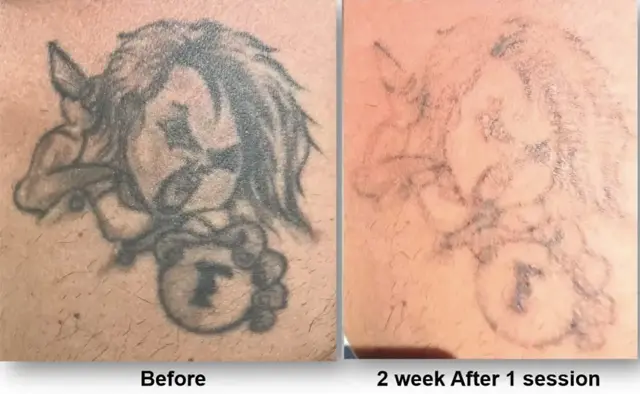 Laser Skin Resurfacing result at ZENA Medical in Newport Beach, CA