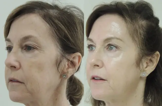 Laser Skin Resurfacing result at ZENA Medical in Newport Beach, CA