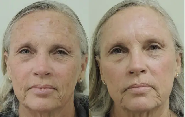 Laser Skin Resurfacing result at ZENA Medical in Newport Beach, CA