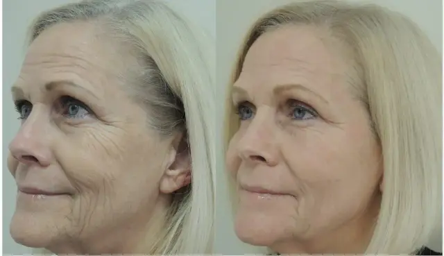 Laser Skin Resurfacing result at ZENA Medical in Newport Beach, CA