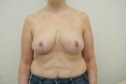 Marc Everett, MD, FACS breast reduction after — New York, NY