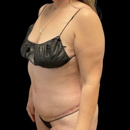 Marc Everett, MD, FACS tummy tuck after — New York, NY