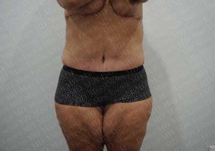 Marc Everett, MD, FACS tummy tuck after — New York, NY