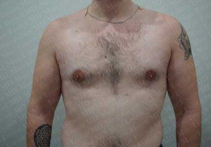 Marc Everett, MD, FACS gynecomastia after — New York, NY