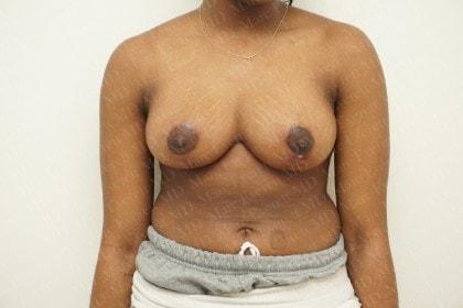 Marc Everett, MD, FACS breast reduction after — New York, NY