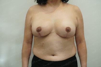 Marc Everett, MD, FACS breast reduction after — New York, NY