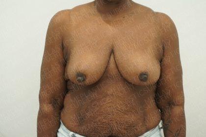 Marc Everett, MD, FACS breast reduction after — New York, NY