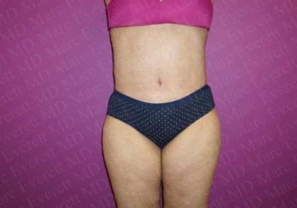 Marc Everett, MD, FACS tummy tuck after — New York, NY