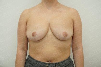 Marc Everett, MD, FACS breast reduction after — New York, NY