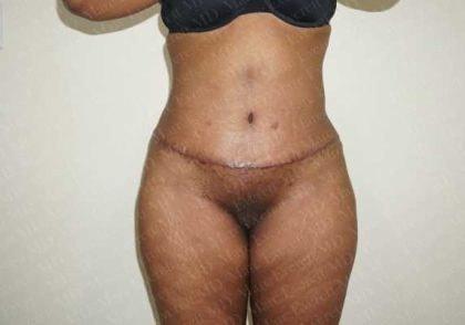 Marc Everett, MD, FACS tummy tuck after — New York, NY