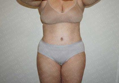 Marc Everett, MD, FACS tummy tuck after — New York, NY
