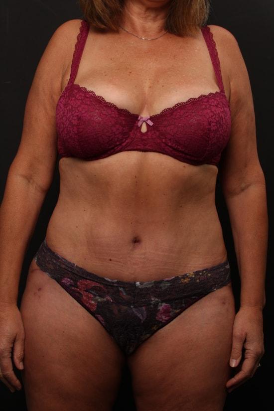 Finesse Plastic Surgery mommy makeover after — Orange, CA