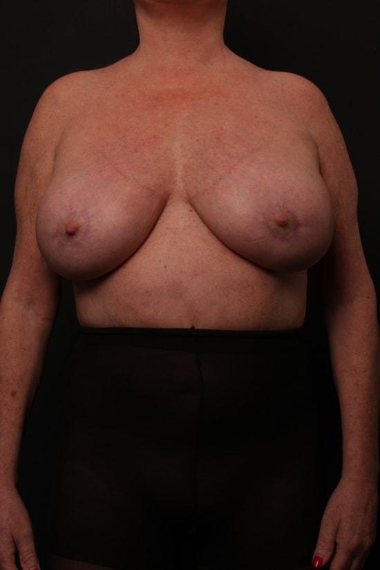 Finesse Plastic Surgery breast augmentation revision after — Orange, CA
