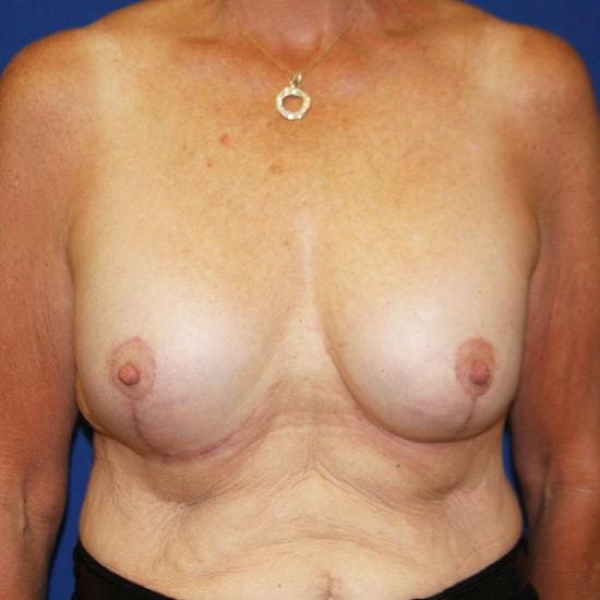 Finesse Plastic Surgery breast augmentation revision after — Orange, CA