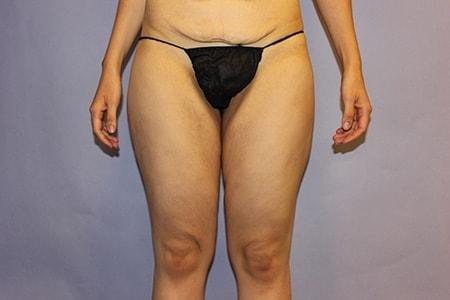 Thigh Lift before at DiFrancesco Plastic Surgery in Atlanta, GA