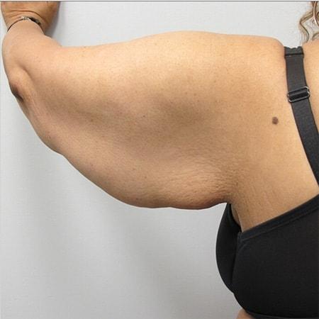 Arm Lift before at DiFrancesco Plastic Surgery in Atlanta, GA