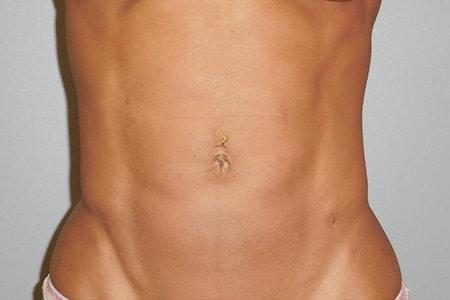 DiFrancesco Plastic Surgery liposuction after — Atlanta, GA