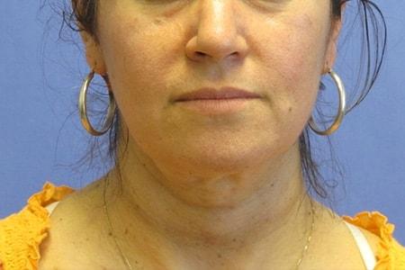 DiFrancesco Plastic Surgery neck liposuction after — Atlanta, GA