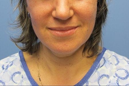 Neck Liposuction before at DiFrancesco Plastic Surgery in Atlanta, GA