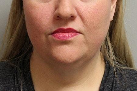 DiFrancesco Plastic Surgery double chin treatment after — Atlanta, GA