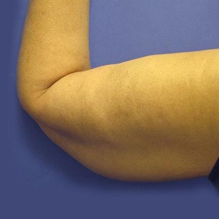 Arm Lift after at DiFrancesco Plastic Surgery in Atlanta, GA