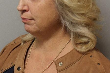 DiFrancesco Plastic Surgery double chin treatment after — Atlanta, GA