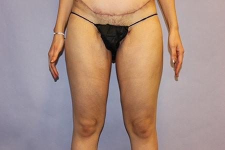 DiFrancesco Plastic Surgery thigh lift after — Atlanta, GA