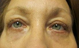 Lake County Plastic Surgery (Aras D. Tijunelis, MD) eyelid lift after — Libertyville, IL