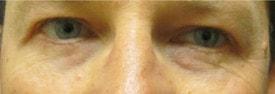 Lake County Plastic Surgery (Aras D. Tijunelis, MD) eyelid lift after — Libertyville, IL
