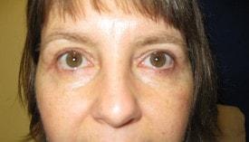 Lake County Plastic Surgery (Aras D. Tijunelis, MD) eyelid lift after — Libertyville, IL