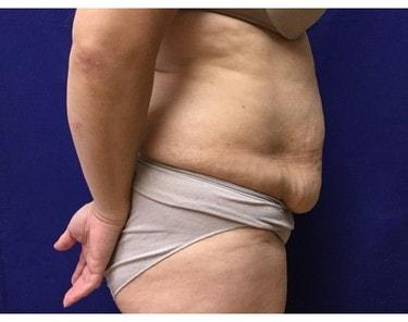 Tummy Tuck before at Lake County Plastic Surgery (Aras D. Tijunelis, MD) in Libertyville, IL