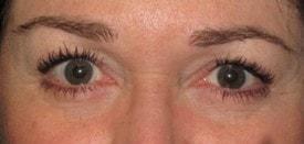 Lake County Plastic Surgery (Aras D. Tijunelis, MD) eyelid lift after — Libertyville, IL