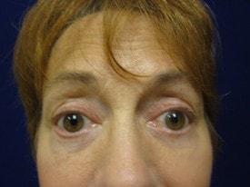Lake County Plastic Surgery (Aras D. Tijunelis, MD) eyelid lift after — Libertyville, IL