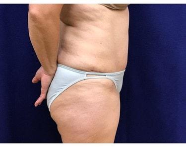 Tummy Tuck after at Lake County Plastic Surgery (Aras D. Tijunelis, MD) in Libertyville, IL