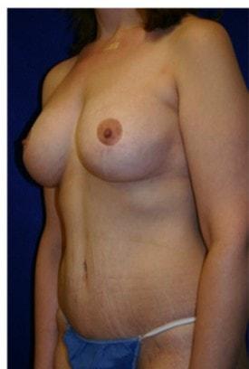 Lake County Plastic Surgery (Aras D. Tijunelis, MD) mommy makeover after — Libertyville, IL